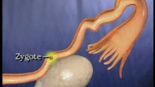 Tubes Tied  Tubal Reversal Video [upl. by Roderick]