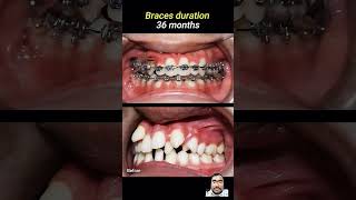 Orthodontics treatment duration and cost Duration 36month cost60k [upl. by Britni]