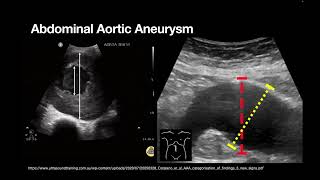 AAA and ABDO Emergencies [upl. by Christmann]