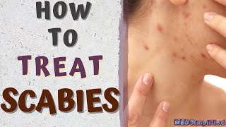 HOW TO TREAT SCABIESscabies treatment at home [upl. by Aseiram51]