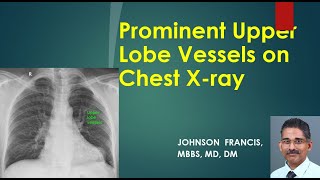 Prominent Upper Lobe Vessels on Chest X ray [upl. by Hsitirb731]