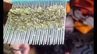 Head lice infestation video will certainly make your skin crawl [upl. by Oglesby]