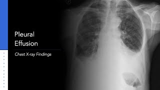 Pleural Effusion Explanation of Xray Findings [upl. by Pippy]