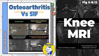 Fig 5B12 Osteoarthritis vs Subchondral Insufficiency Fracture [upl. by Notgnihsaw]