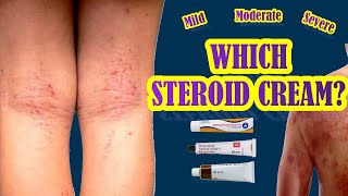 Which Steroid Cream Works Best For Eczema  Mild Moderate Severe Eczema Treatment [upl. by Ylil357]