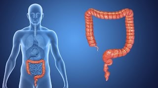 What is Colorectal Cancer [upl. by Aneeres]