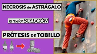 💪 NECROSIS de ASTRAGALO La mejor SOLUCIÓN una PRÓTESIS de TOBILLO [upl. by Huckaby]