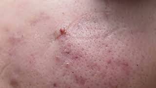 ACNE  Blackhead [upl. by Fezoj]