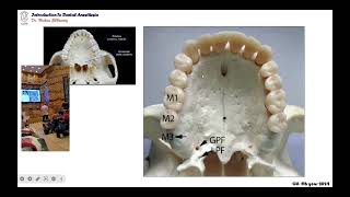 02 maxillary palatal infiltration anesthetic technique [upl. by Joella]