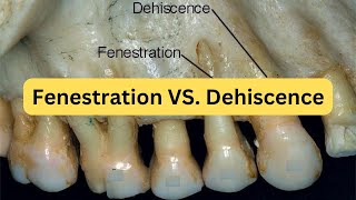 Difference between fenestration and dehiscence with mnemonic [upl. by Gnod]