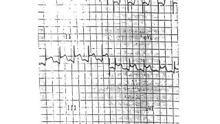 myocarditis pericarditis endocarditis [upl. by Yelrac886]