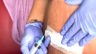 How I Drained My Seroma ‼️ After Lipo and Tummy Tuck [upl. by Orianna]