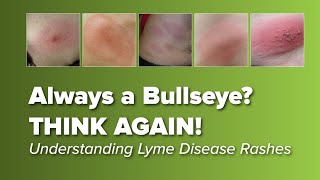 Think the Lyme Disease Rash is Always a Bullseye Think Again  Johns Hopkins Rheumatology [upl. by Leo2]