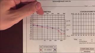 Video de como interpretar una audiometría [upl. by Nairahcaz]