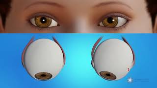 How is strabismus surgery done [upl. by Drofliw40]