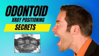 Secret To Odontoid Xray Positioning [upl. by Notyalc]