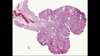 neoplasia robbins pathology full review with combined and enhanced quality [upl. by Nicolis]