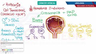 Urología  Cancer vesical [upl. by Audley]