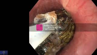 Gastric Bezoar Endoscopic fragmentation [upl. by Ayekal]