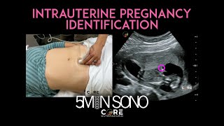 Intrauterine Pregnancy Identification with PointofCare Ultrasound 5MS [upl. by Nylorak963]