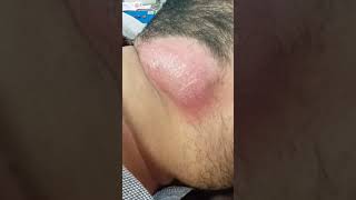 Lymph node abscess  Infected Lymph nodes in the neck  Swelling in the neck shorts shortvideo [upl. by Enelie]