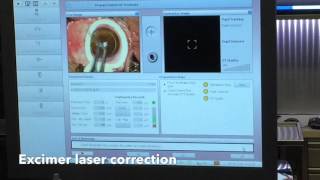 Femtosecond LASIK for Hyperopia correction  Nikos G Tsioumas MD [upl. by Hagar80]