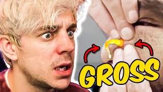 Reacting to the Grossest Pimple Popping Videos [upl. by Bickart999]