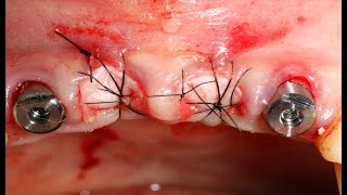 Immediate implantation amp Socket preservation on Maxillary Anterior Dr Sang Chul Lims commentary [upl. by Ayatnohs]