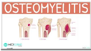 Osteomyelitis Classification Causes Pathophysiology Signs and Symptoms Diagnosis and Treatment [upl. by Peper620]