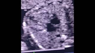 fetal echo showing hypoplastic tv intact septum suggestive of pulmonary atresia intact ivschd [upl. by Eislrahc126]