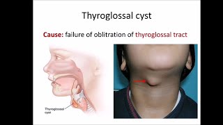 Thyroglossal cyst [upl. by Ynaffat]