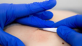 How to get rid of Skin Tags  Advanced electrolysis [upl. by Derfiniw]