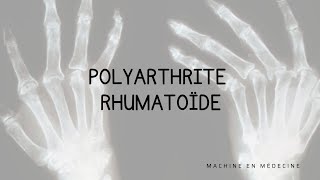 Polyarthrite Rhumatoïde PR [upl. by Idorb]