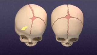 Craniosynostosis  Mayo Clinic [upl. by Bork]