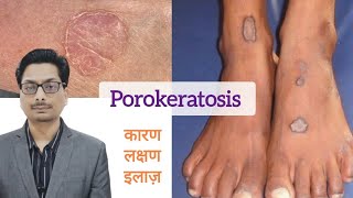 Porokeratosis का कारण लक्षण और इलाज़  Porokeratosis और cancer porokeratosis skincancer cancer [upl. by Polash]