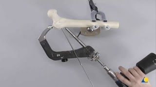 Intramedullary Fixation using the Advanced Proximal Femoral Nailing System TFNA [upl. by Feucht]