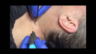 Skin tag removal on neck skintag [upl. by Ahsenra]