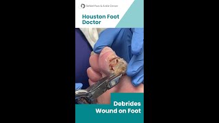 Wound Debridement by Houston Foot Doctor woundcare podiatrist footdoctor [upl. by Tallula115]