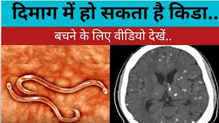 NCC  Neurocysticercosis  दिमाग में कीड़ा न्यूरोसिस्टीसर्कोसिस [upl. by Amabelle]