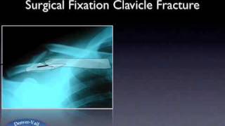 Treatment of Clavicle Fractures [upl. by Arriet]