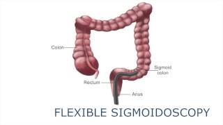 Flexible sigmoidoscopy [upl. by Hopfinger]