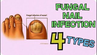 4 TYPES OF FUNGAL NAIL INFECTIONS YOU MAY HAVE TOENAIL FUNGUS [upl. by Adlei]