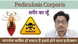 शरीर का जूँ  Body Lice  जानलेवा साबित हो सकता है इससे होने वाला इन्फेक्शन  Pediculosis Corporis [upl. by Nirehtak]