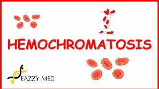 Hemochromatosis causespathophysiologysigns and symptomsdiagnosis and treatment [upl. by Pansir]