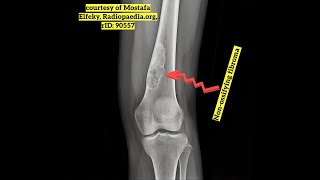 NonOssifying Fibromas Explained What Every Parent Should Know [upl. by Convery]