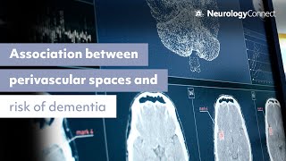 Perivascular Spaces on MRI May Be Associated with Increased Risk of Dementia [upl. by Steen177]