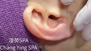 清粉刺推薦耳朵黑頭Blackheads on ear Removal 耳の角栓耳掃除 [upl. by Aihsein]