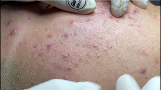 Acne treatment for Spa Linh Mun 2024 85 [upl. by Holton344]