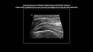 Subacromial impingement on dynamic realtime shoulder ultrasound case 3 [upl. by Idaf]