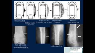 Bone Lesions Radiographic Assessment Part 1 by Geoffrey Riley MD [upl. by Emelen]